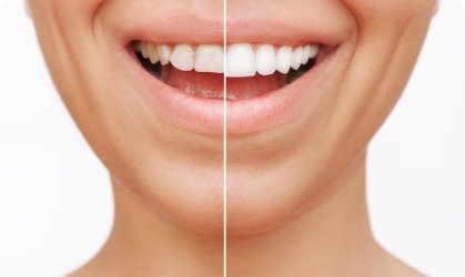 Teeth Whitening