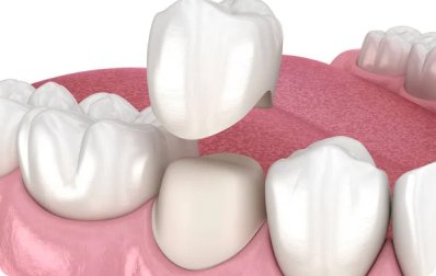 Dental Crowns