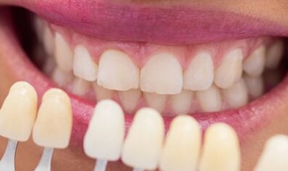 Veneers