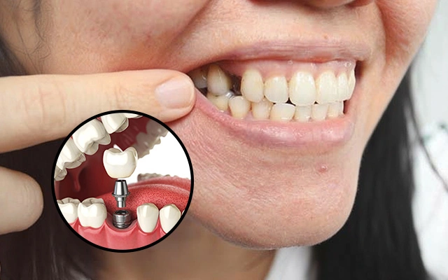 Tooth Missing Why Delaying Dental Implants Can Damage Nearby Teeth