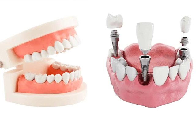 Dental Implants vs Dentures