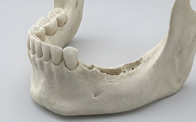 Missing teeth and jawbone loss