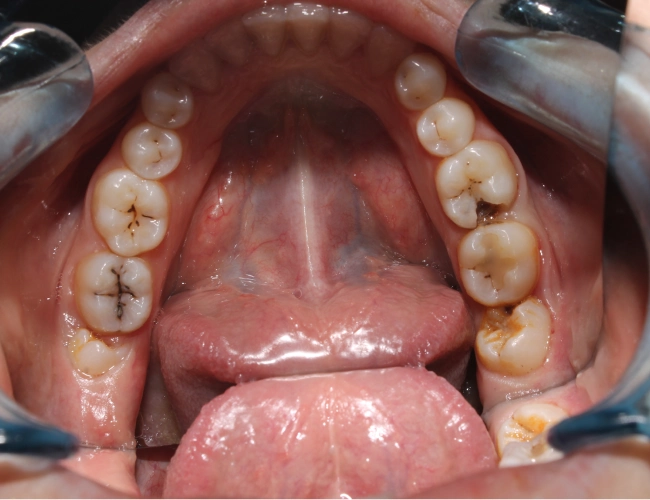 Cavities