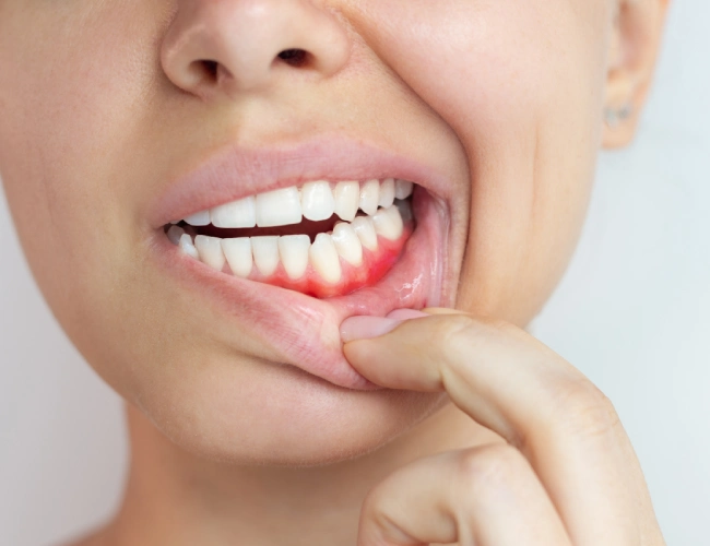 Gum Disease